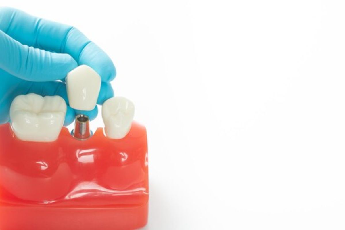 Dental-implants-in-Bentonville