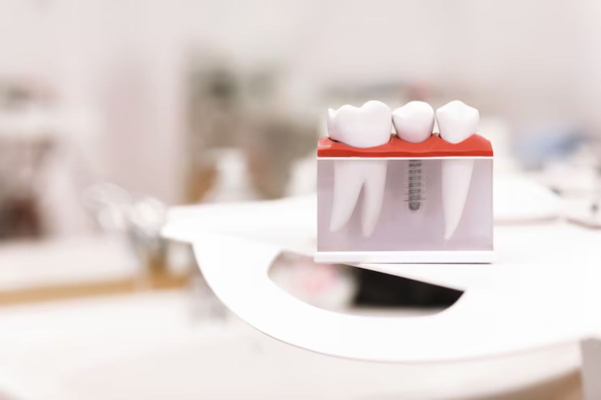 Dental Implants in Bentonville