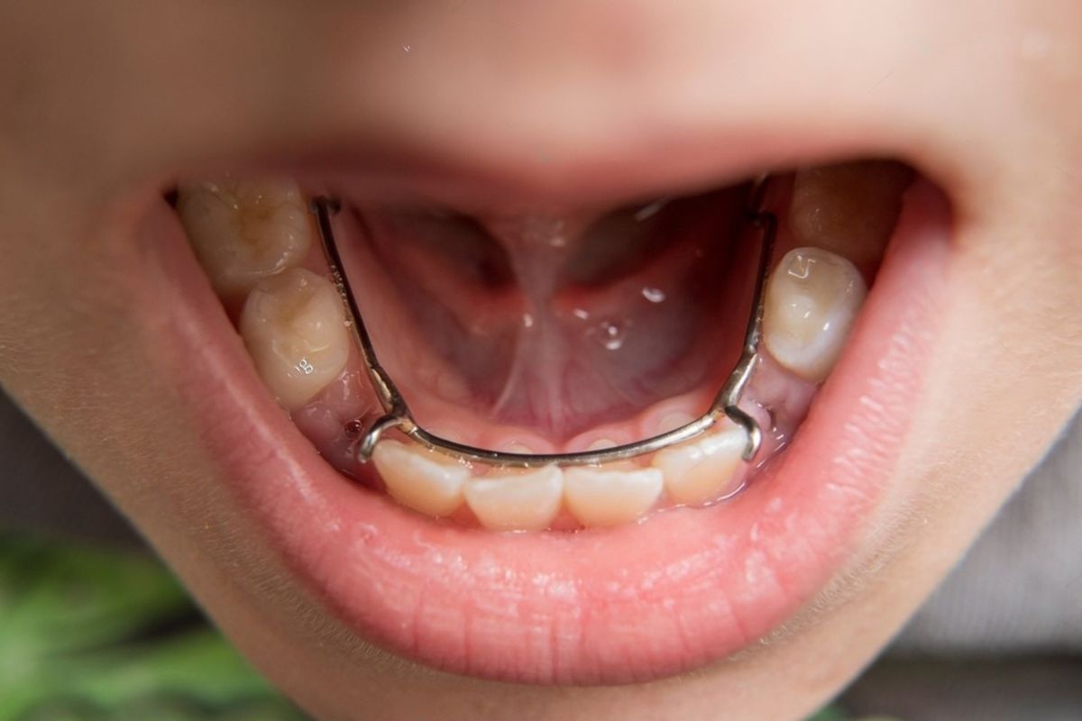 Space maintainer used by a kid