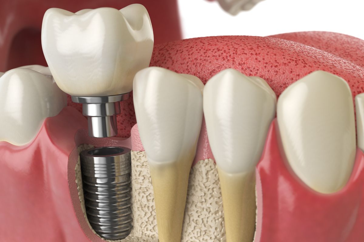 dental implants Bentonville