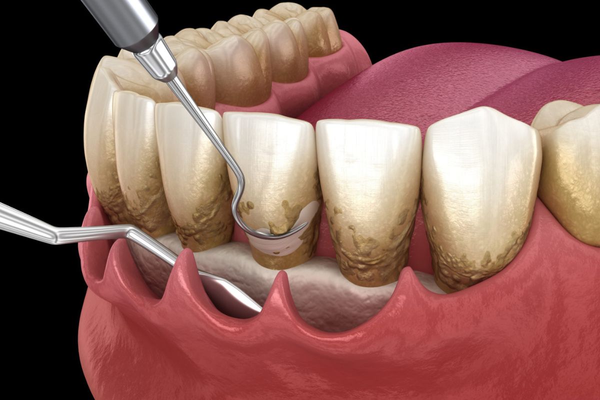 gum disease treatment in Bentonville