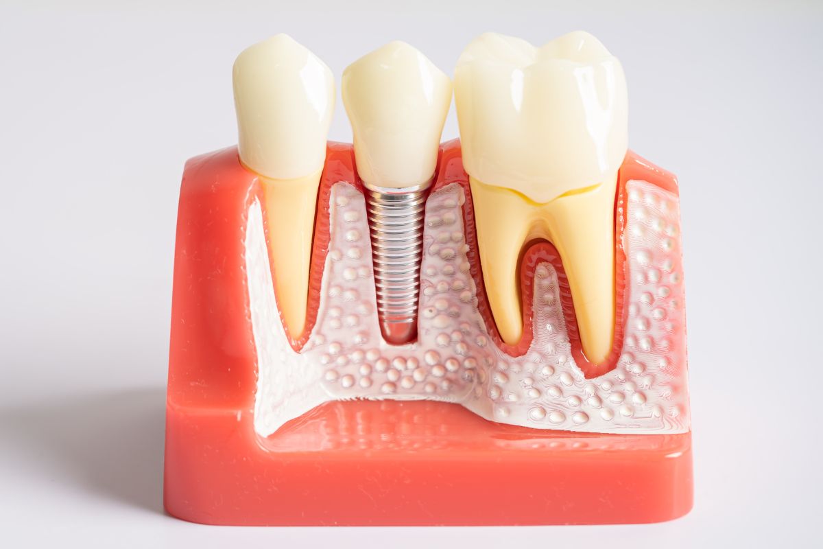 Dental implants 3D Model | Bentonville Dentist | Dentist Near Me