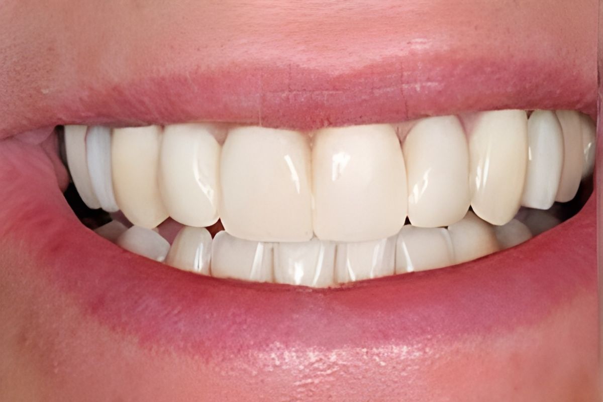 Teeth Whitening Cosmetic Dentist in Bentonville AR