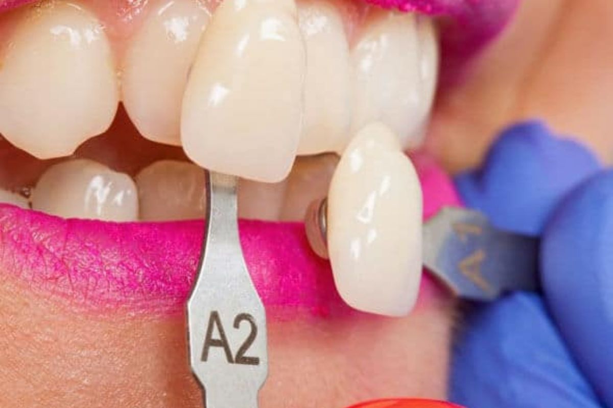 Veneers- Cosmetic Dentistry in Bentonville, AR