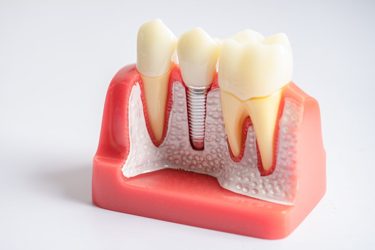 dental-implants-bentonville-ar