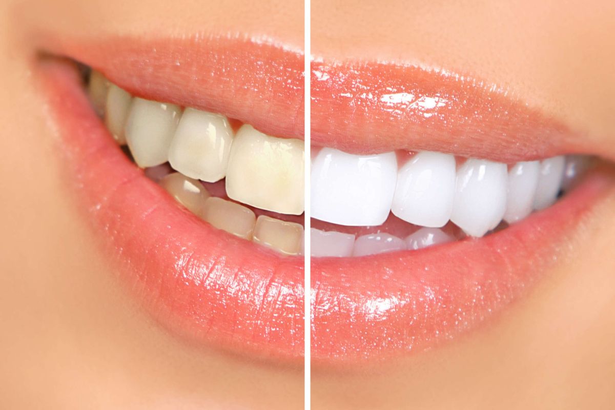 teeth-whitening-before-after-image